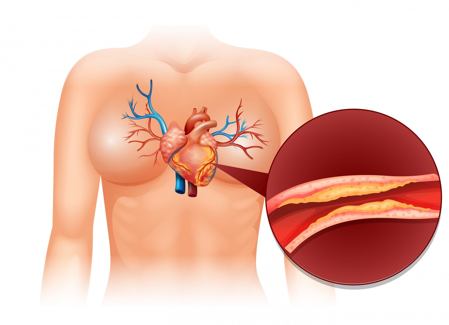 Radial Angiography