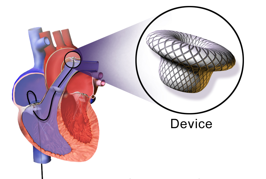 Device Closure