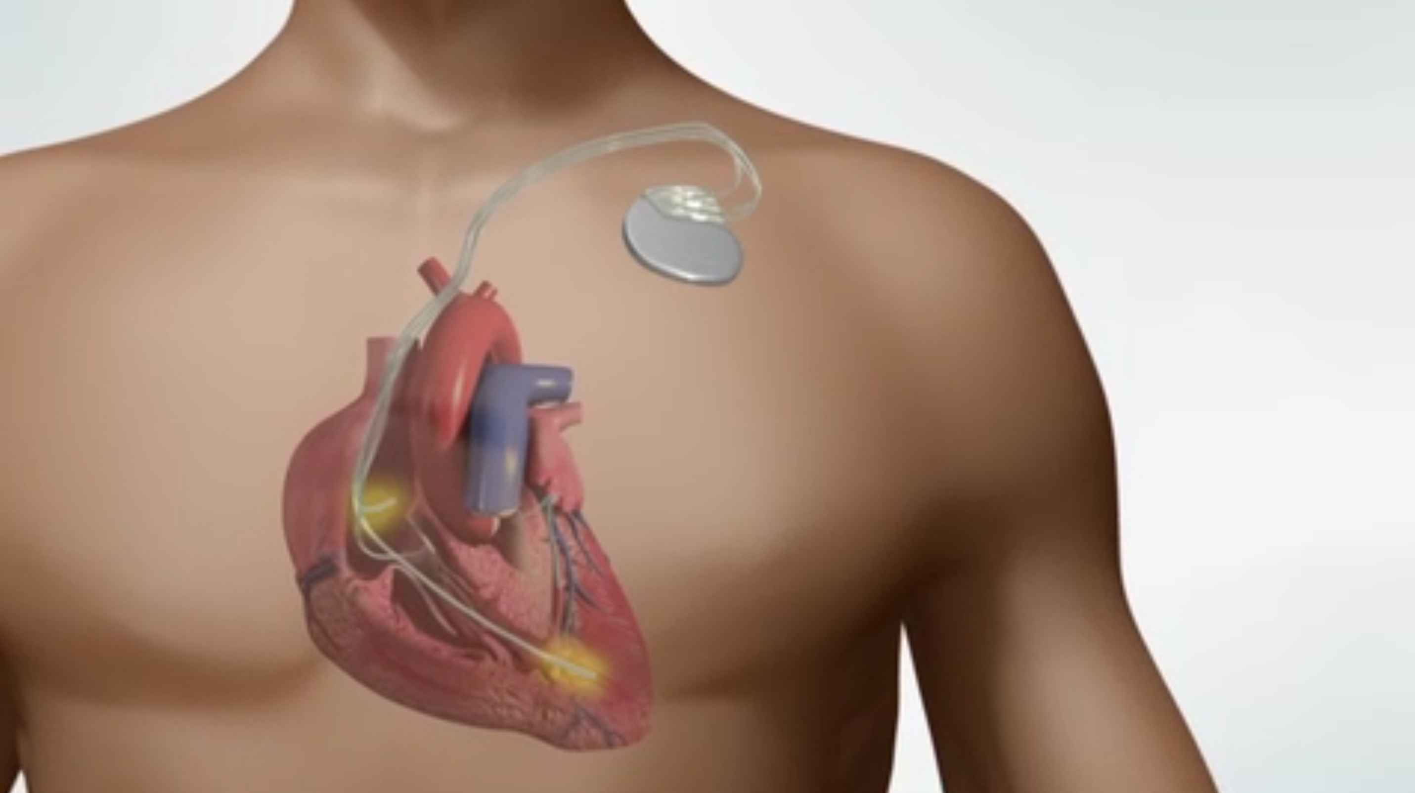 Pacemaker Implantation