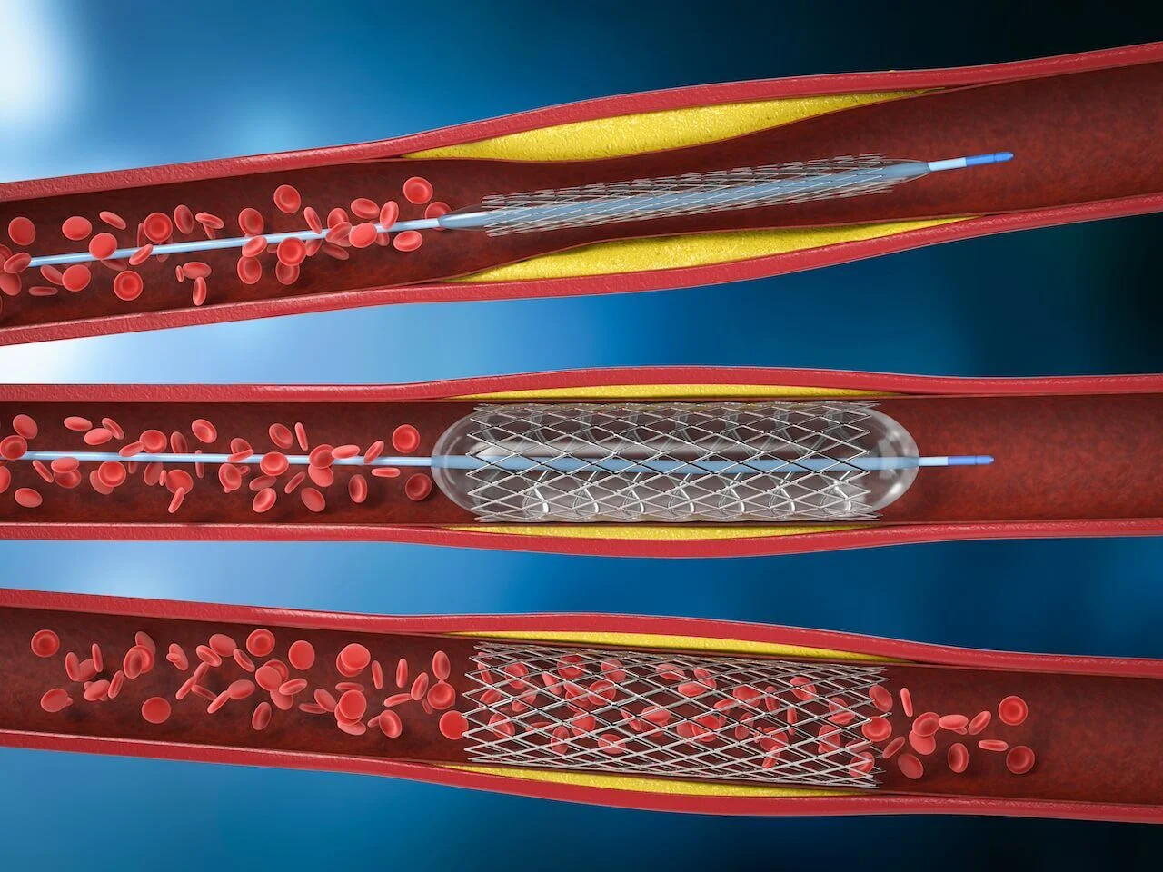 Peripheral Interventions